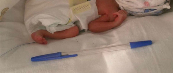 Бурятские врачи выходили новорождённую длиной с ручку 